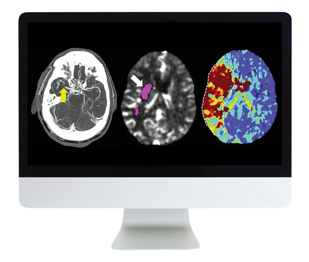 ARRS Code Stroke: What Every Radiologist Should Know 2022 (Videos)