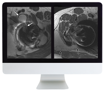 ARRS Controversies In Hip And Pelvis Imaging 2016