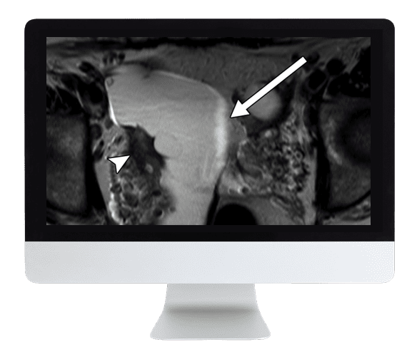 ARRS Pitfalls in GI Imaging 2022
