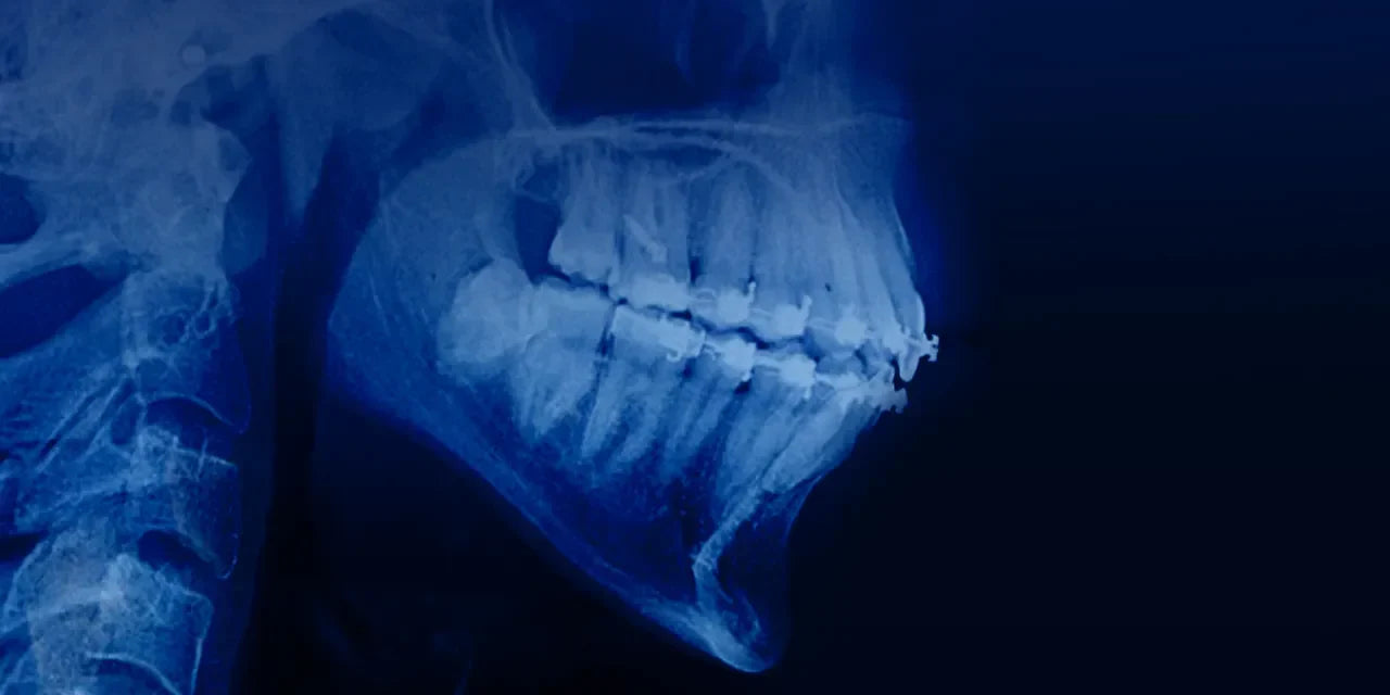 OHI-S Orthodontic treatment in patients with periodontal and alveolar bone pathology
