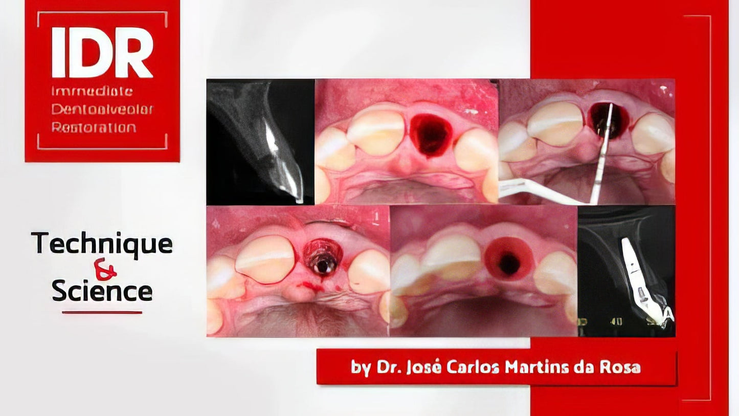 Pikos Institute Immediate Dentoalveolar Restoration