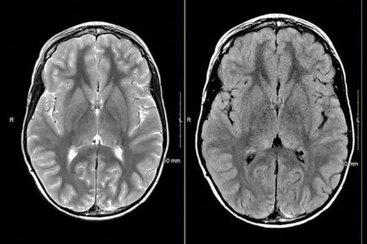 MRIOnline Mastery Series: Neurofibromatosis Type 1 (NF1) 2021  VIDEOS)