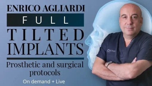Full tilted implants Prosthetic and Surgical protocols 2023 (Osteocom)