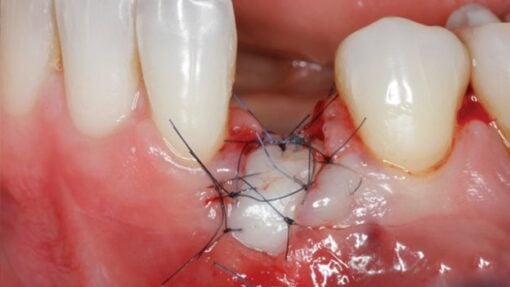 Gidedental Soft Tissue Management around Natural Teeth and Dental Implants 2020 ( VIDEOS)